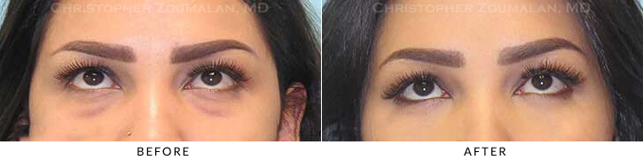 Lower Lid Blepharoplasty Before & After Photo - Patient Seeing Up - Patient 34C