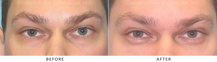 Lower Lid Blepharoplasty Before & After Photo - Patient Seeing Straight - Patient 35A
