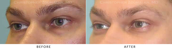 Lower Lid Blepharoplasty Before & After Photo - Patient Seeing Side - Patient 35B