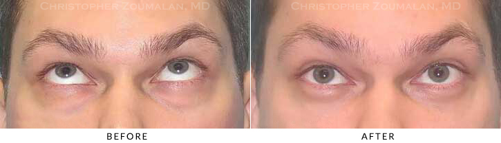 Lower Lid Blepharoplasty Before & After Photo - Patient Seeing Up - Patient 35C