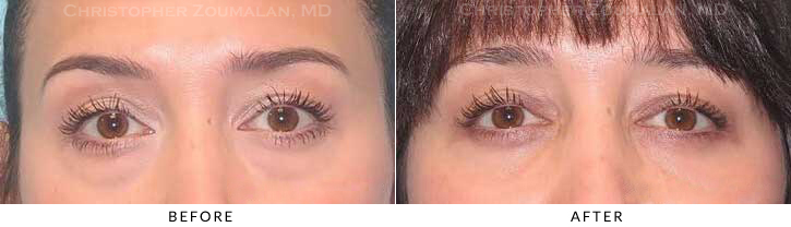 Lower Lid Blepharoplasty Before & After Photo - Patient Seeing Straight - Patient 37A