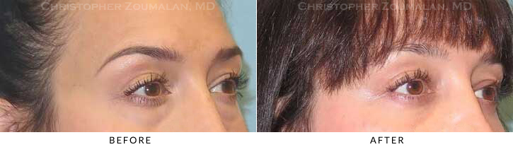 Lower Lid Blepharoplasty Before & After Photo - Patient Seeing Side - Patient 37B