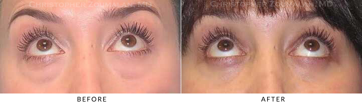 Lower Lid Blepharoplasty Before & After Photo - Patient Seeing Up - Patient 37C