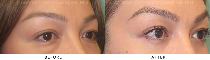 Lower Lid Blepharoplasty Before & After Photo - Patient Seeing Side - Patient 38A