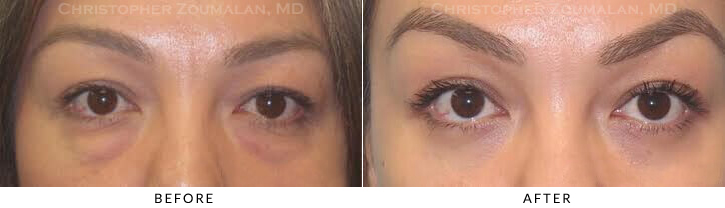 Lower Lid Blepharoplasty Before & After Photo - Patient Seeing Straight - Patient 38B
