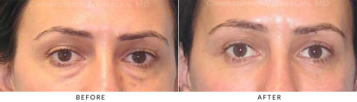 Lower Lid Blepharoplasty Before & After Photo - Patient Seeing Straight - Patient 39A