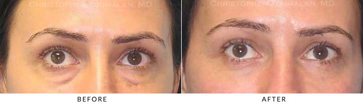 Lower Lid Blepharoplasty Before & After Photo - Patient Seeing Up - Patient 39B
