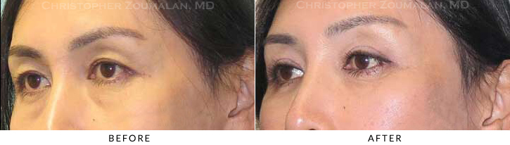 Lower Lid Blepharoplasty Before & After Photo - Patient Seeing Side - Patient 40B