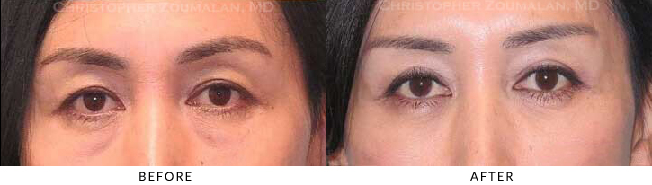 Lower Lid Blepharoplasty Before & After Photo - Patient Seeing Straight - Patient 40C