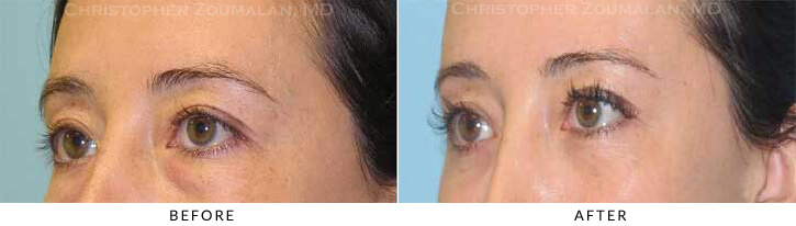 Lower Lid Blepharoplasty Before & After Photo -  - Patient 41A