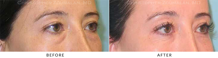 Lower Lid Blepharoplasty Before & After Photo - Patient Seeing Side - Patient 41C