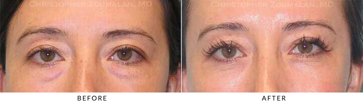 Lower Lid Blepharoplasty Before & After Photo - Patient Seeing Up - Patient 41B