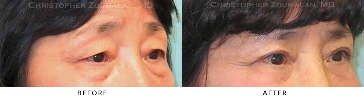 Lower Lid Blepharoplasty Before & After Photo - Patient Seeing Side - Patient 42A