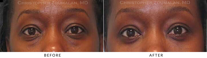 Lower Lid Blepharoplasty Before & After Photo - Patient Seeing Straight - Patient 43A