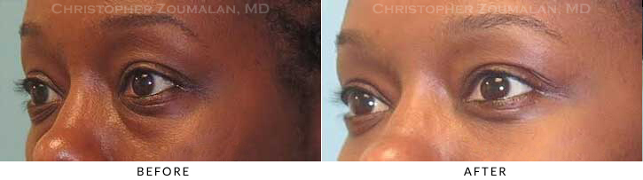 Lower Lid Blepharoplasty Before & After Photo - Patient Seeing Side - Patient 43B