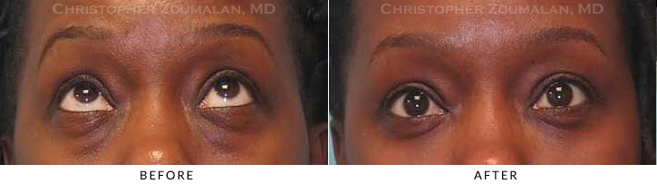 Lower Lid Blepharoplasty Before & After Photo - Patient Seeing Up - Patient 43C