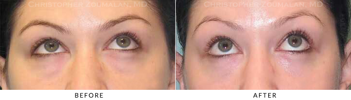 Lower Lid Blepharoplasty Before & After Photo - Patient Seeing Up - Patient 44A