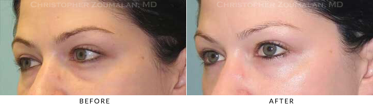 Lower Lid Blepharoplasty Before & After Photo - Patient Seeing Side - Patient 44B