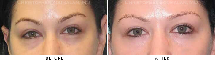 Lower Lid Blepharoplasty Before & After Photo - Patient Seeing Straight - Patient 44C