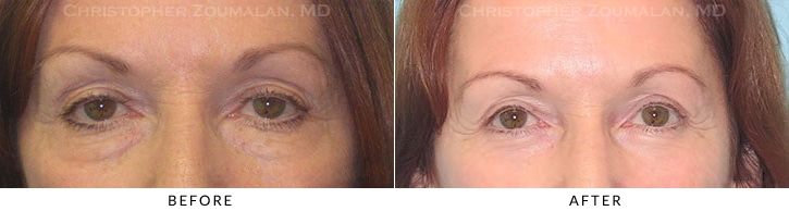Lower Lid Blepharoplasty Before & After Photo -  - Patient 45