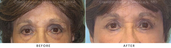 Lower Lid Blepharoplasty Before & After Photo -  - Patient 47