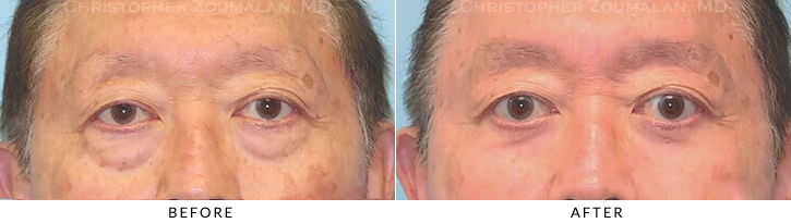 Lower Lid Blepharoplasty Before & After Photo -  - Patient 48