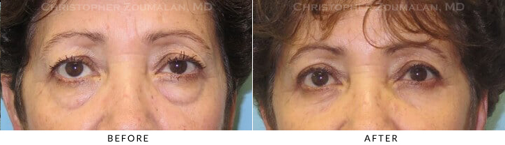 Lower Lid Blepharoplasty Before & After Photo - Patient Seeing Straight - Patient 49A