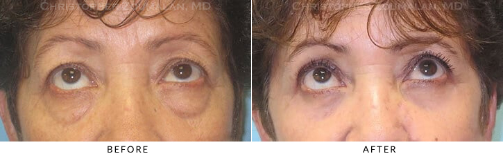 Lower Lid Blepharoplasty Before & After Photo - Patient Seeing Up - Patient 49B