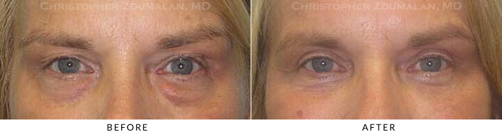 Lower Lid Blepharoplasty Before & After Photo - Patient Seeing Straight - Patient 50A