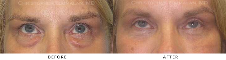 Lower Lid Blepharoplasty Before & After Photo - Patient Seeing Up - Patient 50B
