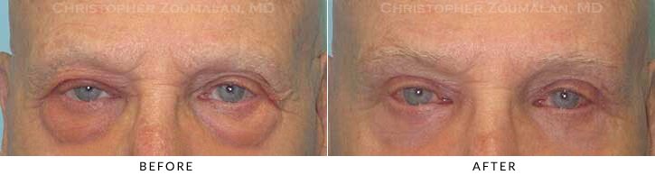 Lower Lid Blepharoplasty Before & After Photo -  - Patient 51