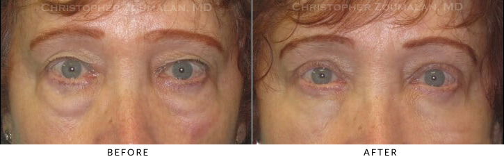Lower Lid Blepharoplasty Before & After Photo -  - Patient 52