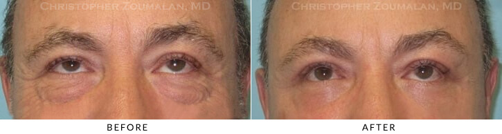 Lower Lid Blepharoplasty Before & After Photo - Patient Seeing Up - Patient 53A