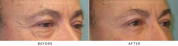 Lower Lid Blepharoplasty Before & After Photo - Patient Seeing Side - Patient 53C