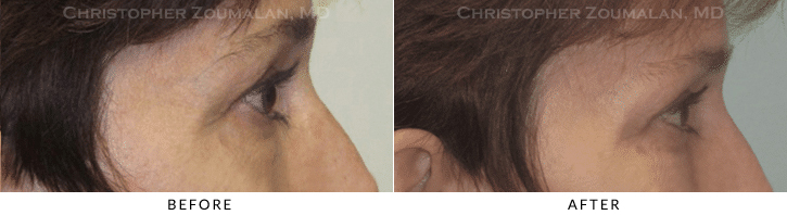 Lower Lid Blepharoplasty Before & After Photo - Patient Seeing Side - Patient 55A