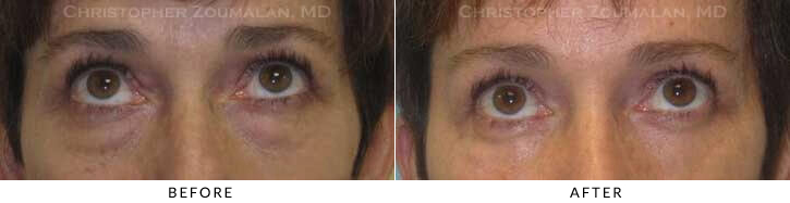 Lower Lid Blepharoplasty Before & After Photo - Patient Seeing Up - Patient 55C