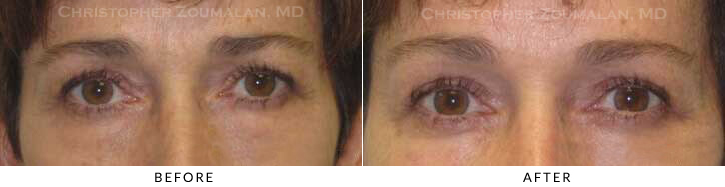 Lower Lid Blepharoplasty Before & After Photo - Patient Seeing Straight - Patient 55B