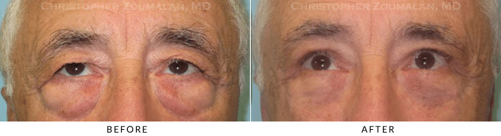 Lower Lid Blepharoplasty Before & After Photo - Patient Seeing Up - Patient 57A