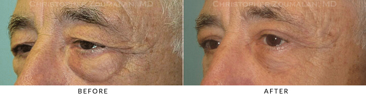 Lower Lid Blepharoplasty Before & After Photo - Patient Seeing Side - Patient 57B