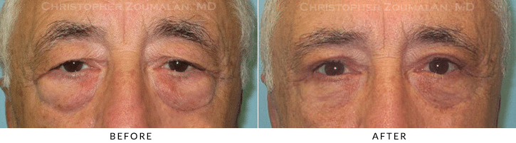 Lower Lid Blepharoplasty Before & After Photo - Patient Seeing Straight - Patient 57C