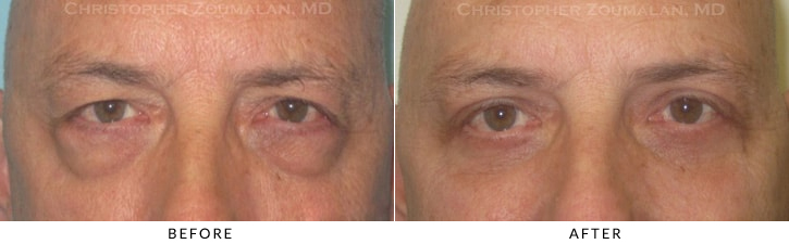 Lower Lid Blepharoplasty Before & After Photo -  - Patient 58