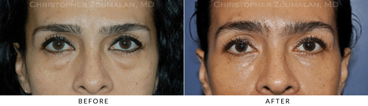 Lower Lid Blepharoplasty Before & After Photo -  - Patient 59