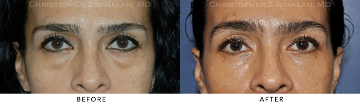 Lower Lid Blepharoplasty Before & After Photo -  - Patient 59