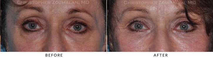 Lower Lid Blepharoplasty Before & After Photo -  - Patient 61