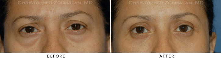 Lower Lid Blepharoplasty Before & After Photo -  - Patient 62
