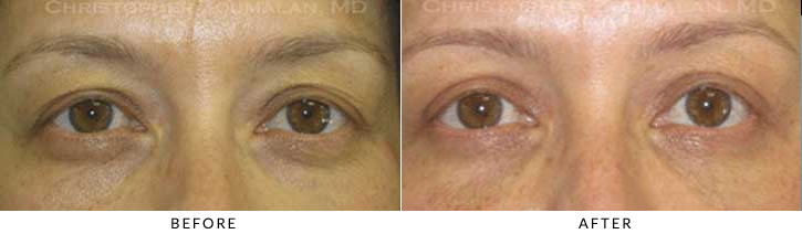 Lower Lid Blepharoplasty Before & After Photo -  - Patient 66