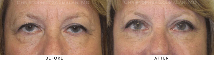 Lower Lid Blepharoplasty Before & After Photo -  - Patient 65