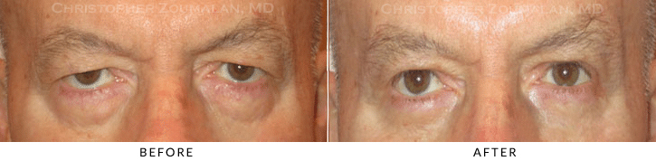 Lower Lid Blepharoplasty Before & After Photo -  - Patient 64