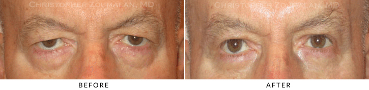 Lower Lid Blepharoplasty Before & After Photo -  - Patient 64