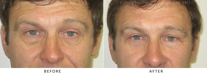 Lower Lid Blepharoplasty Before & After Photo - Patient Seeing Straight - Patient 67A
